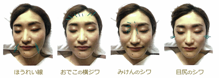 シワ・ほうれい線~美容鍼イメージ~